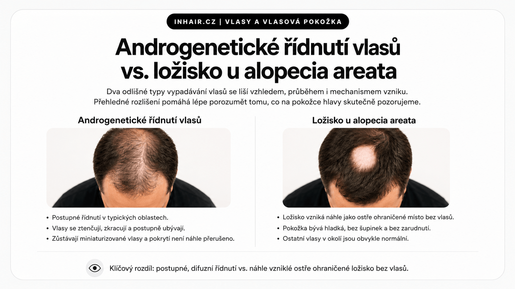 Androgenetické a ložiskové vypadávání