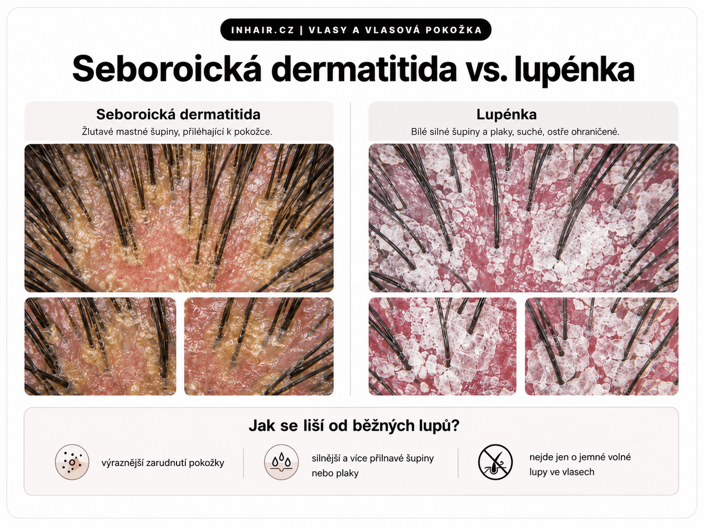 Seboroická dermatitida / lupénka